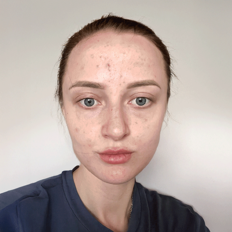 Resultate Irritated Skin trockener Haut Pickeln Mitessern Flecken